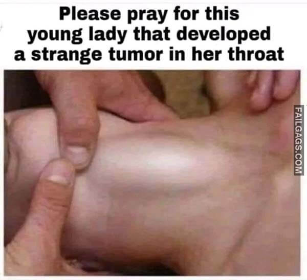 Please Pray For This Young Lady That Developed A Strange Tumor In Her Throat Meme